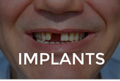 Dental Implants