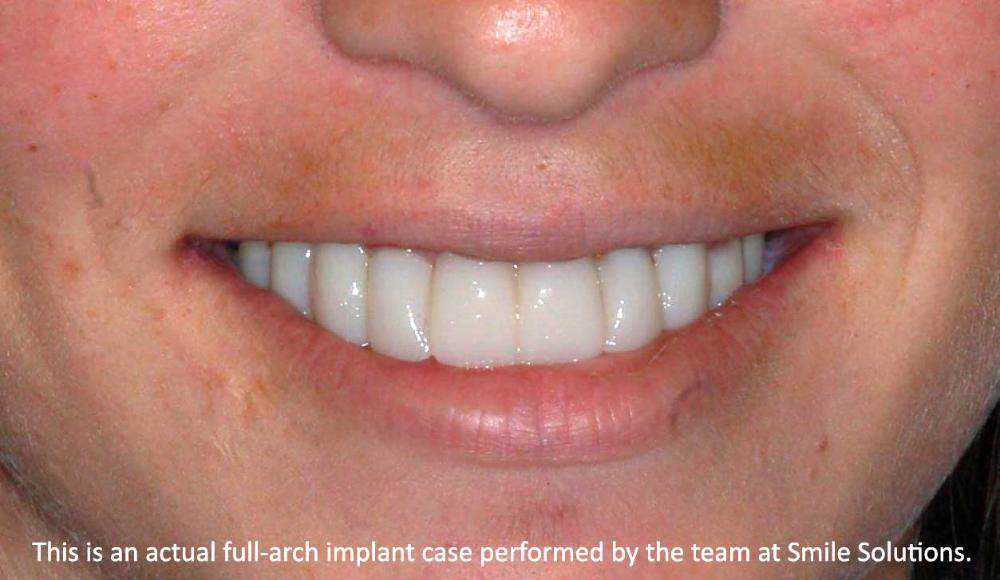 Implants Scottsboro, AL